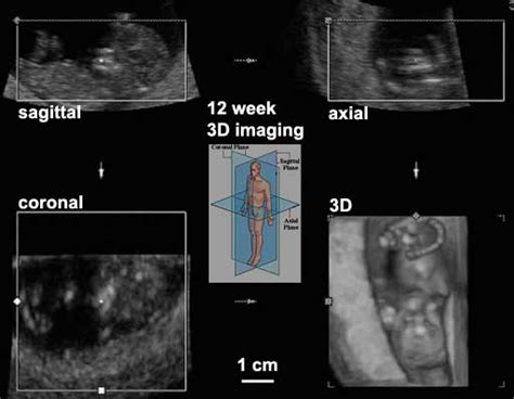 Ultrasound Embryology