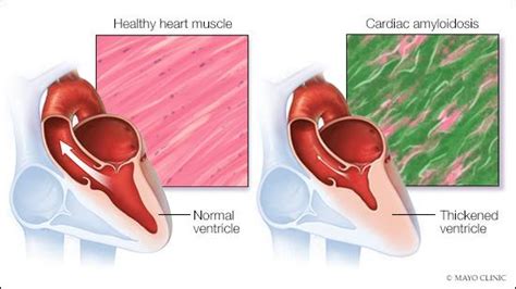 Cardiac Amyloidosis 101 Why Early Diagnosis And Targeted Treatment Matter Mayo Clinic News