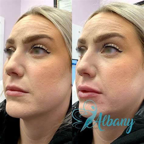 Lip Injections Case No 1386 Albany Cosmetic And Laser Centre In Edmonton