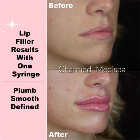 Lip Filler A Variety Of Techniques Charmed Medispa