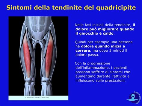 Tendinite Al Quadricipite La Vera Causa E I Sintomi Principali