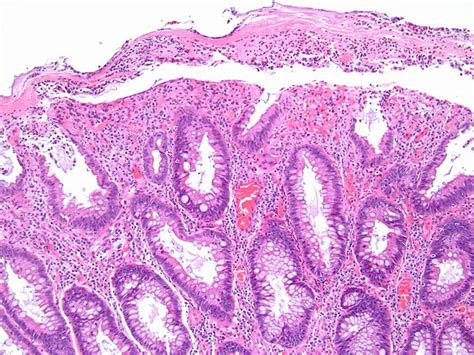 Pathology Outlines Inflammatory Cap Polyp