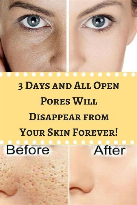 How To Get Rid Of Enlarged Pores Naturally Reduce Pore Size Reduce Pores Enlarged Pores