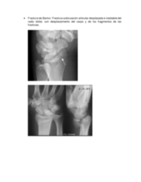 Solution Fracturas De Nombre Propio Y Ligamento De Pata De Ganso