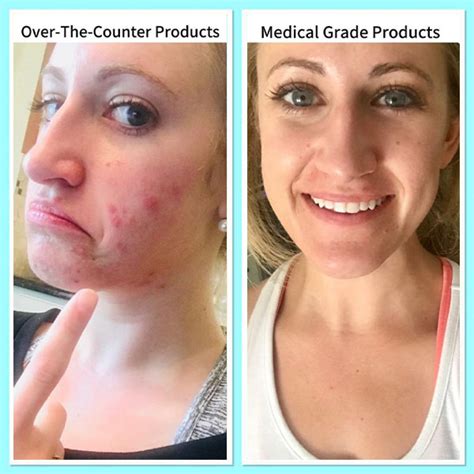 Acne Transformation Renew Md Facial Aesthetics