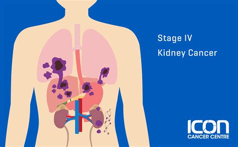 Kidney Cancer Types, Signs, Symptoms & Stages