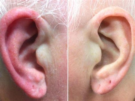 Seborrheic Eczema In Ear