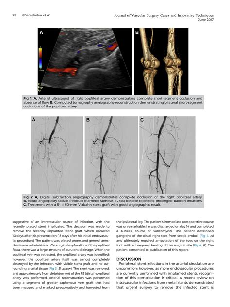 Solution Acute Infection Of Viabahn Stent Graft In The Popliteal