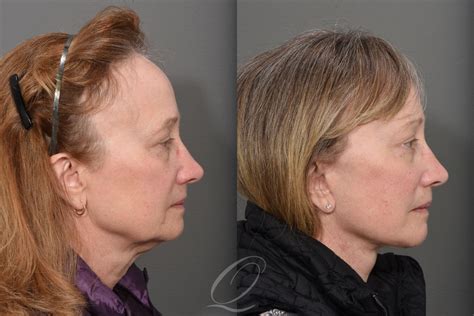 Facelift Before After Photos Patient 1465 Serving Rochester