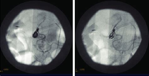 Arteriography With Embolization Of The Gastroduodenal Artery Aneurism