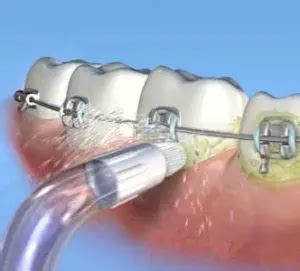 Top Waterpiks For Braces - Floss Best With Water - DentalsReview