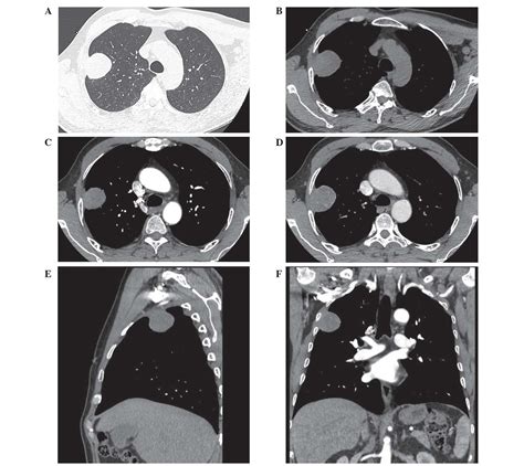 Hepatoid adenocarcinoma of the lung without production of α fetoprotein