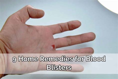 9 Home Remedies for Blood Blisters - Home Remedies