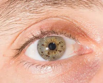 Nevus (Eye Freckle) - American Academy of Ophthalmology