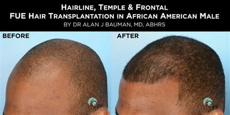 Before After African Afro Caribbean Ethnic Fue Hair Transplant Using