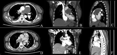 Pulmonary Artery Sarcoma Misdiagnosed As Pulmonary Embolism Journal