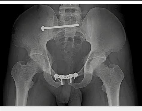 Figure 17 From Management Of Neglected Pubic Symphysis Diastasis And Sacroiliac Joint Disruption