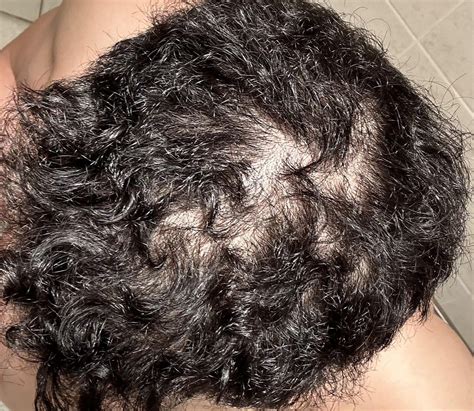 Hair loss - Telogen Effluvium : r/malegrooming