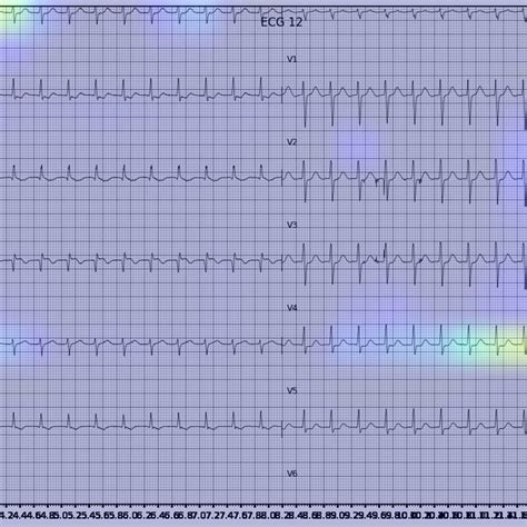 Example Of An Activation Heatmap For An Ecg Showing Wpw Download Scientific Diagram