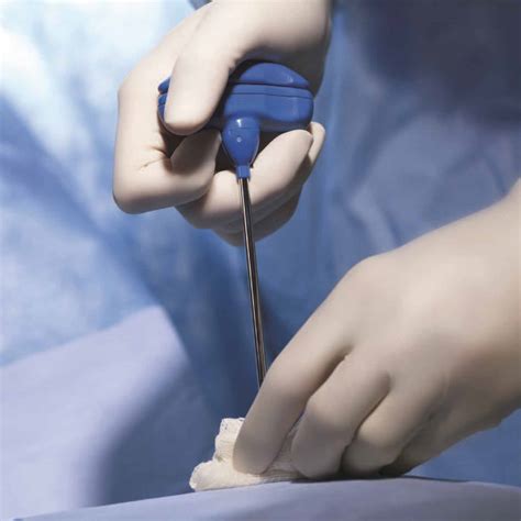 Jamshidi™ bone marrow biopsy needles – Iskus Health