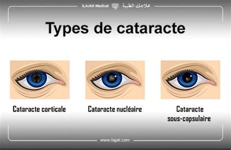 Tout Savoir Sur La Cataracte Ilajak