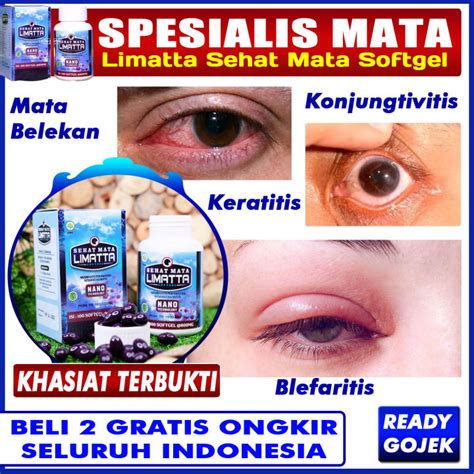 Obat Mata Belekan Blefaritis Peradangan Kelopak Mata Mata Merah