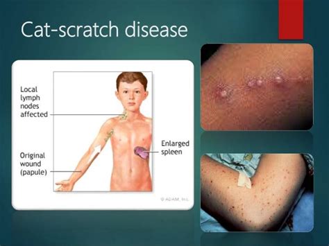 Cat scratch disease