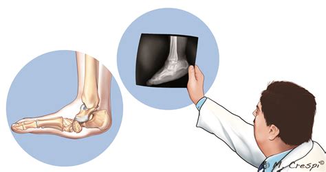 The Experts Definition Of Diabetic Charcot Foot Orthofix