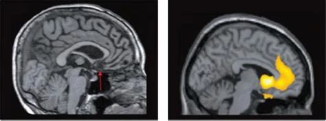 Demenza Frontotemporale Pre Senile Come Fare Diagnosi Differenziale