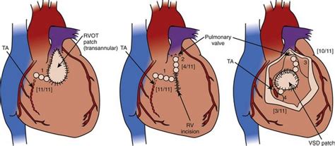 Arrhythmias Associated With Congenital Heart Disease Thoracic Key