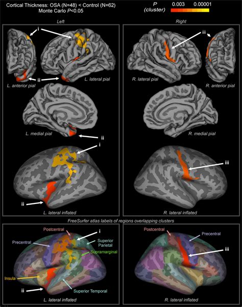 Cortical thinning in OSA. Regions showing cortical thinning in OSA ...