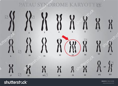 Patau Syndrome Karyotype One Chromosomal Disorders: เวกเตอร์สต็อก (ปลอด ...