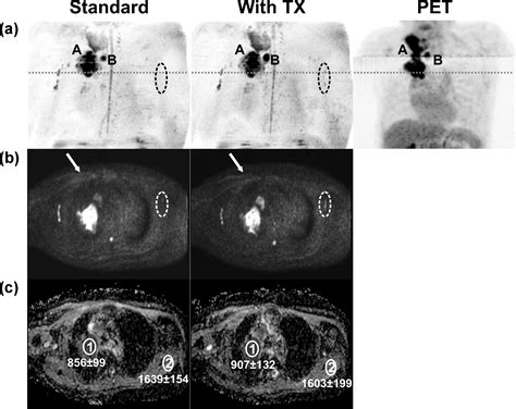 Evaluation Of Dual Source Parallel Rf Excitation For Diffusion Weighted