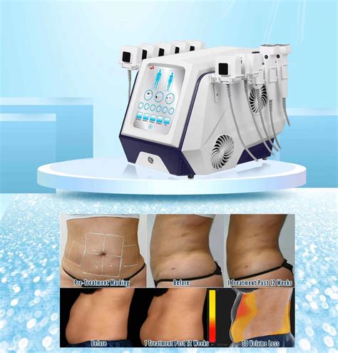 Cutera Non Invasive Fat Removal Cellulite Reduction Slimming