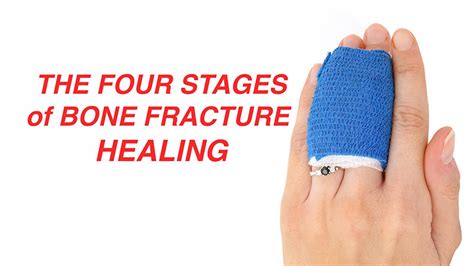 Video The Four Stages Of Bone Fracture Healing Ucsd Tv University