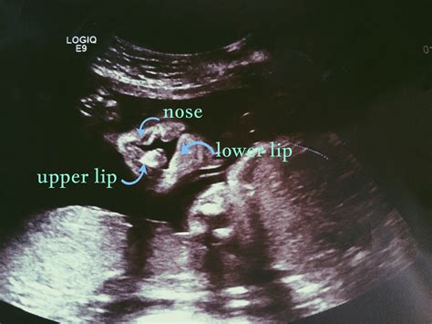 Ultrasound of Cleft. Cleft lip and palate blog | Cleft lip, Cleft lip ...