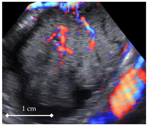 Diagnostics Free Full Text 4d Doppler Ultrasound In High Grade Serous Ovarian Cancer