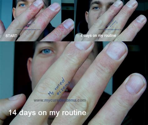 How I cured my dyshidrotic eczema on fingers