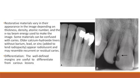 Radiographic Of Interpretation Of Dental Caries Ppt