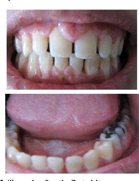 Figure 2 From A Case Of Gingival Enlargement In Acute Myeloid Leukemia