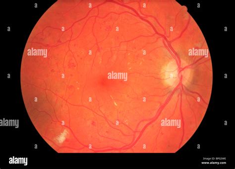 Retinopatía diabética proliferativa fotografías e imágenes de alta