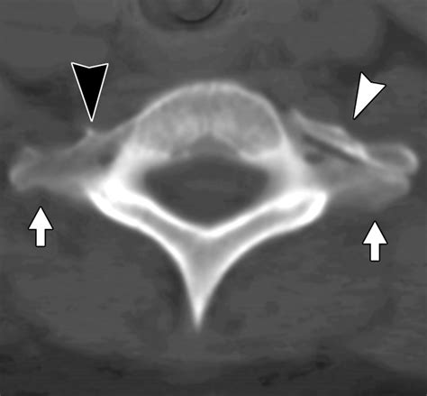 Mdct Of Variations And Anomalies Of The Neural Arch And Its Processes Part 2—articular