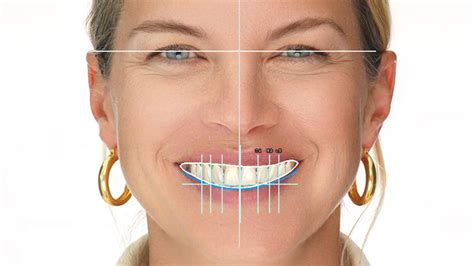 Digital Smile Design An Innovative Tool In Cosmetic