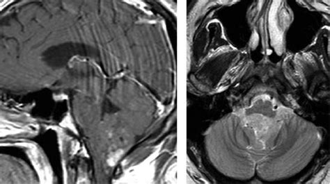 脑室内肿瘤手术策略与技巧 The Neurosurgical Atlas全文翻译 搜狐