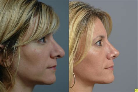 Nose Surgery Before After Long Island Dr James Marotta