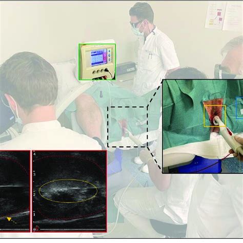 Periprocedural Overview Of A Transperineal Focal Laser Ablation Tpla