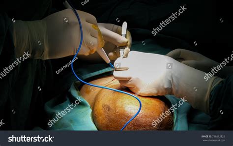 Surgery On Huge Inguinal Hernia Stock Photo (Edit Now) 746812825