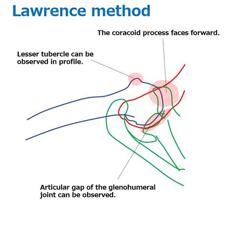 Shoulder Joint Axial View Superior Inferior Axial View Lawrence