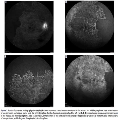 KlinikaOczna On Twitter Idiopathic Retinal Vasculitis Aneurysms And