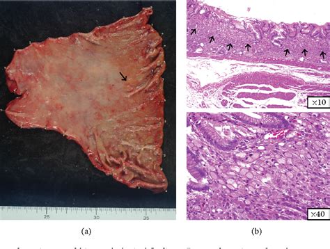 Figure 1 From Intramucosal Signet Ring Cell Gastric Cancer Diagnosed 15